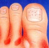 Le champignon sur les jambes