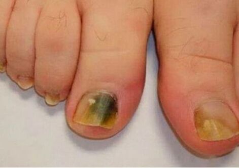 L'infection affecte les plaques d'ongles
