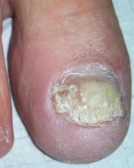 Le champignon sur les jambes