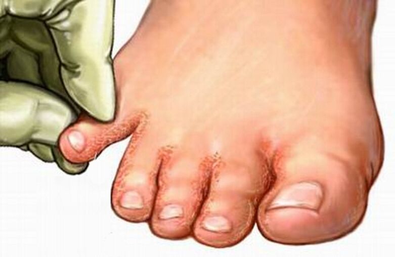 Le champignon sur les jambes