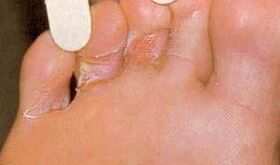 Blessures de dermaid pour la mycose du pied