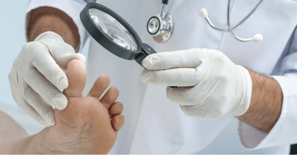 Les premiers symptômes du champignon sur les jambes