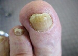 Les causes de l'apparition du champignon sur les ongles