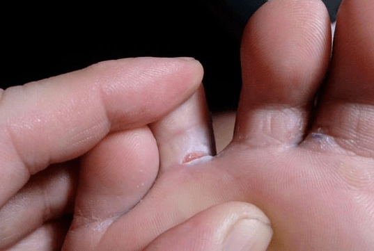L'apparition de formations de bulles sur les pieds