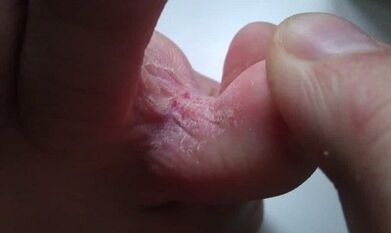 Phase du développement du champignon entre les doigts des pieds