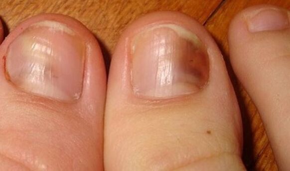 ongles affectés par des champignons