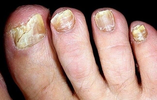 champignon sur les ongles