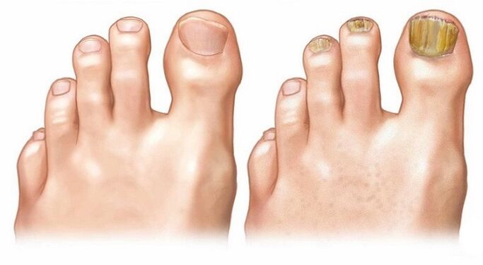 ongles sains et mycose des ongles des pieds